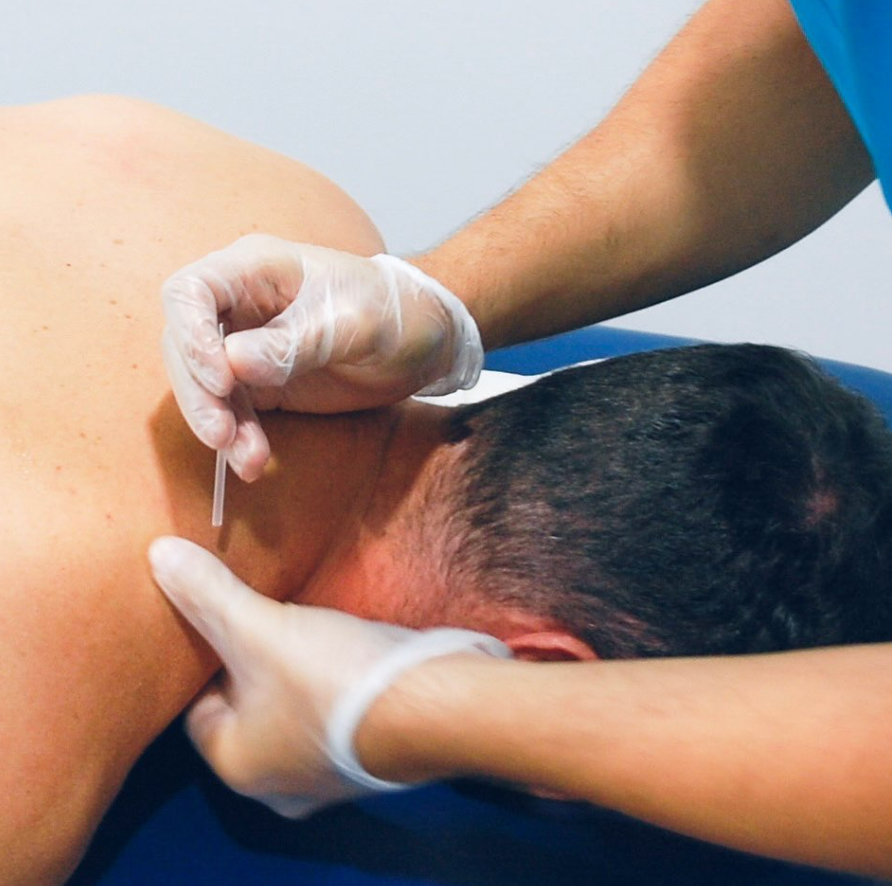 Punción seca en Torremolinos