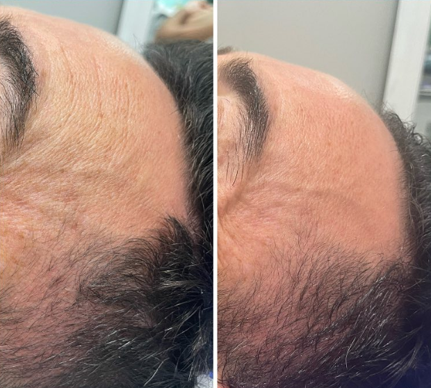 Radiofrecuencia con WINBACK